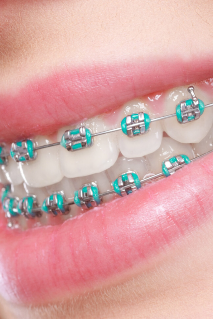 The Ultimate Guide To Orthodontic Treatment The Braces Guide