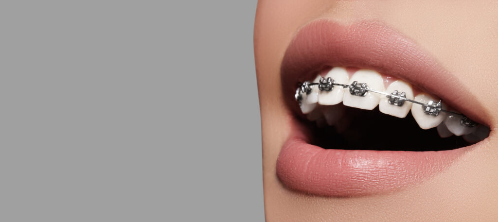 TPA Appliance with Braces: Everything You Need to Know - The Braces Guide