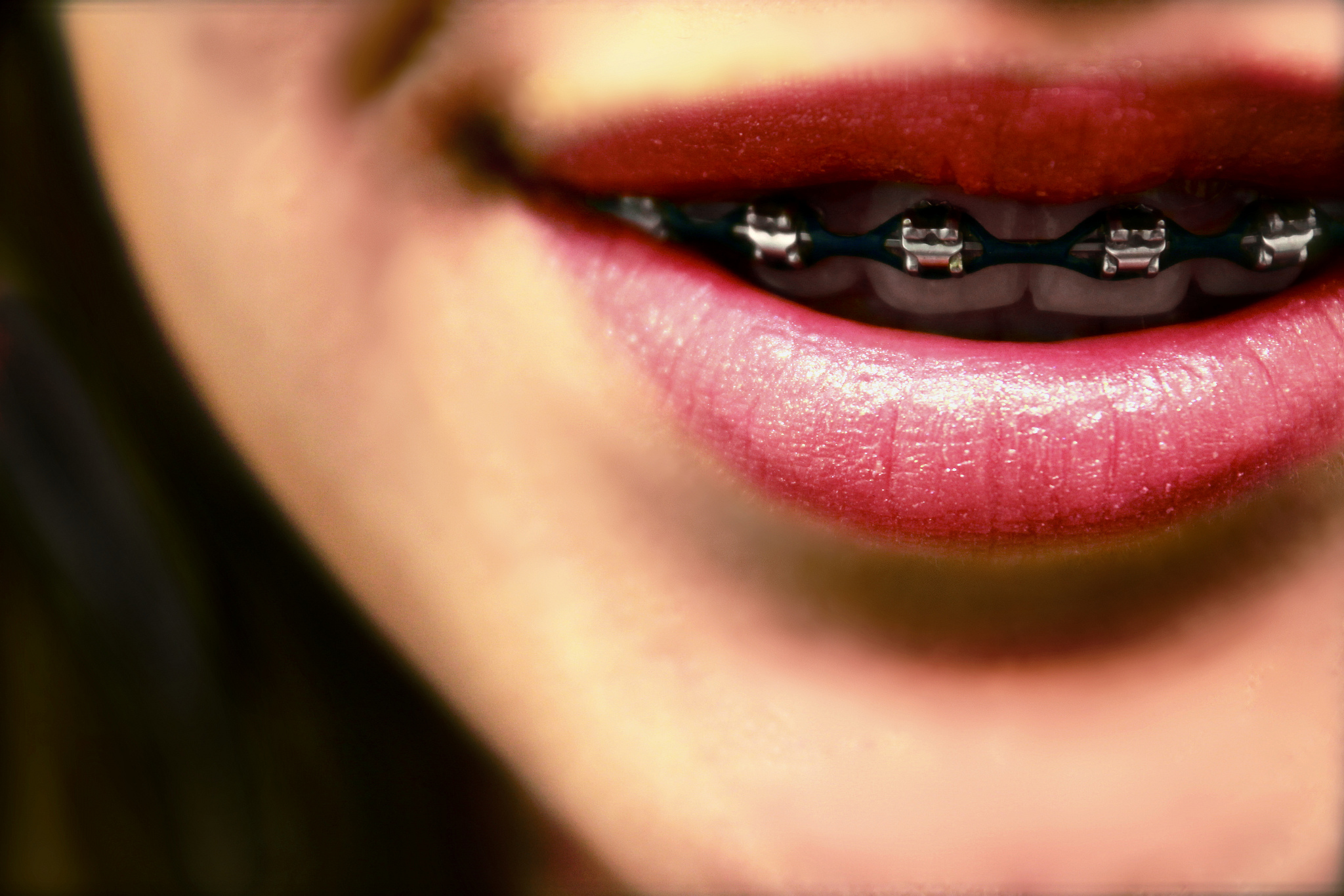 black braces for teeth