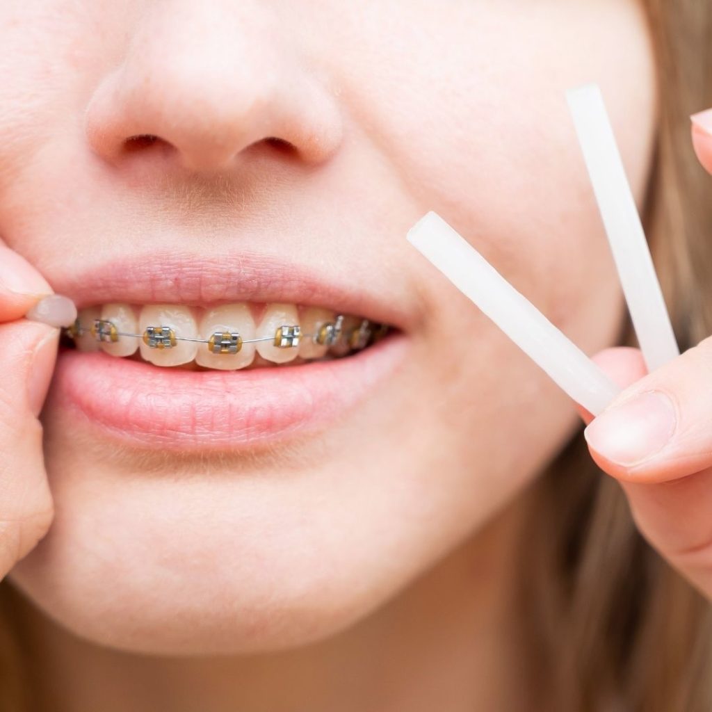 Can You Sleep with Wax on Your Braces? The Braces Guide